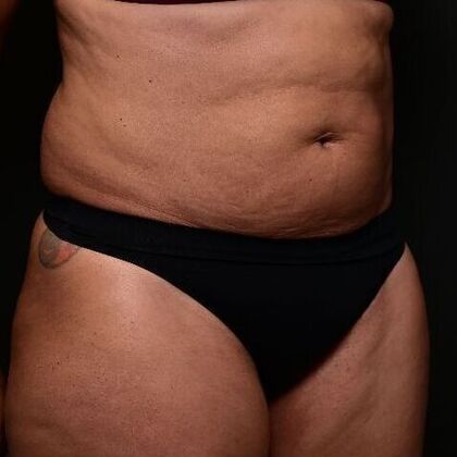 Liposuction and Lipocontouring: Case 1 - Before