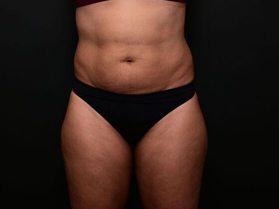 Liposuction Case 1 - Before