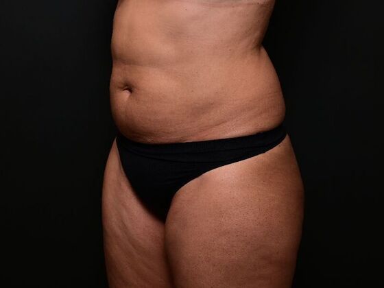 Liposuction: Case 1 - Before