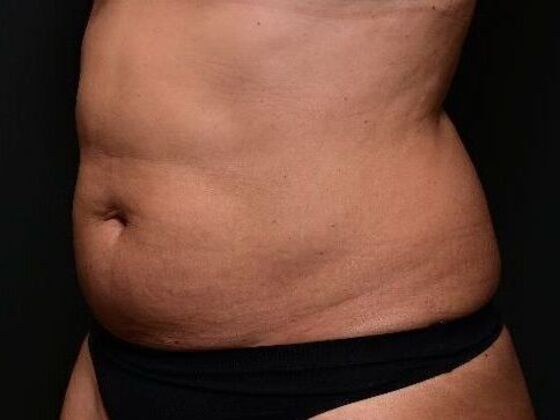 Liposuction and Lipocontouring Case 1 - Before