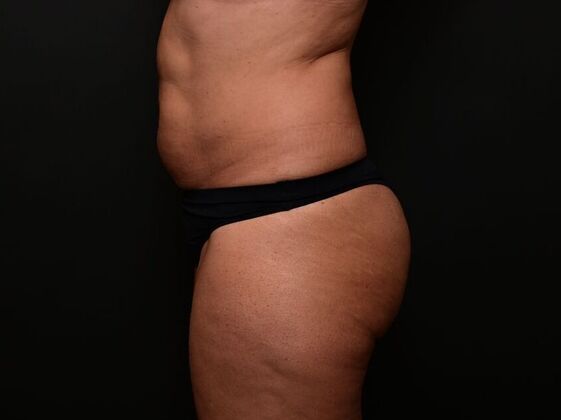 Liposuction: Case 1 - Before
