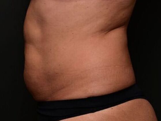 Liposuction and Lipocontouring: Case 1 - Before