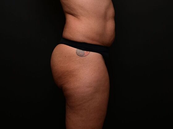 Liposuction: Case 1 - Before
