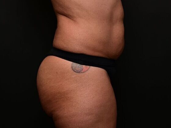Liposuction and Lipocontouring: Case 1 - Before
