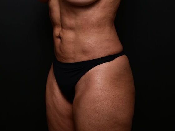 Liposuction: Case 1 - After