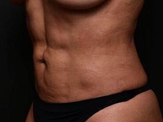 Liposuction and Lipocontouring Case 1 - After