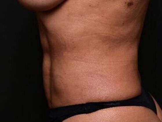 Liposuction and Lipocontouring: Case 1 - Before