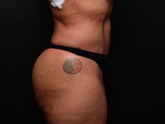 Liposuction: Case 1 - After