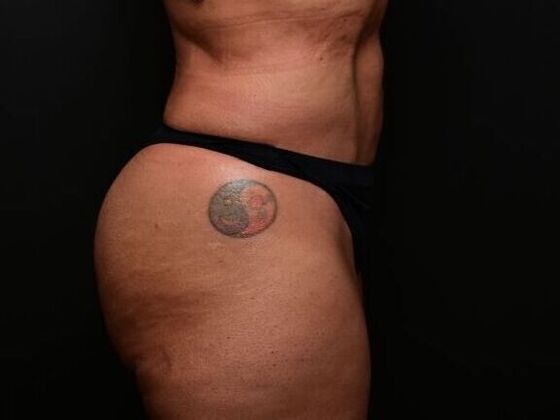 Liposuction and Lipocontouring: Case 1 - After