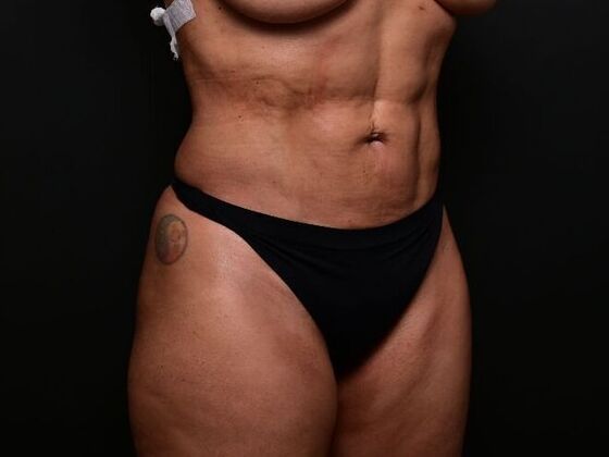 Liposuction: Case 1 - After