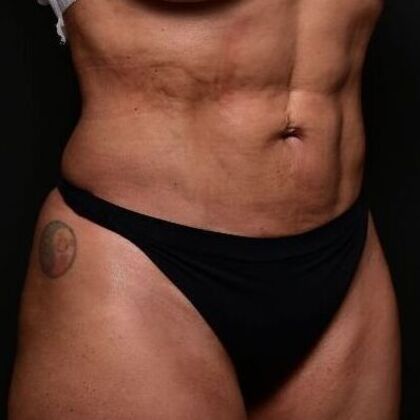 Liposuction and Lipocontouring: Case 1 - After