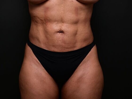 Liposuction Case 1 - After