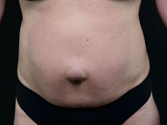 Tummy Tuck with Contouring: Case 8 - Before