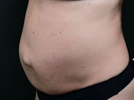 Tummy Tuck with Contouring: Case 8 - Before
