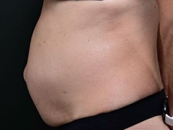 Tummy Tuck with Contouring: Case 8 - Before