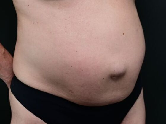 Tummy Tuck with Contouring: Case 8 - Before