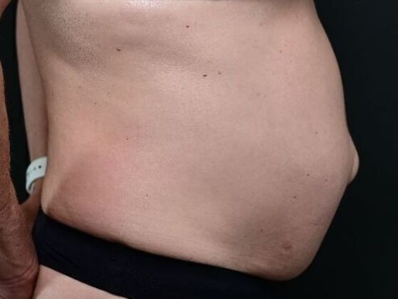 Tummy Tuck with Contouring: Case 8 - Before