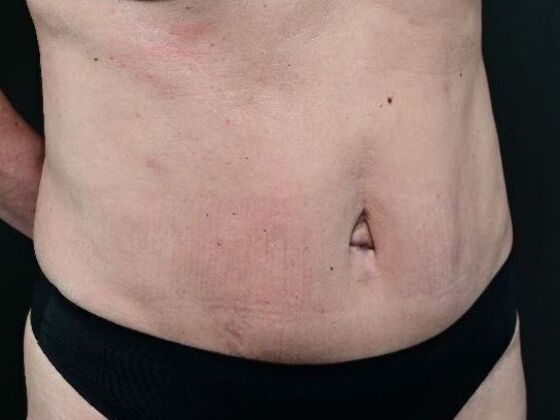 Tummy Tuck with Contouring: Case 8 - After