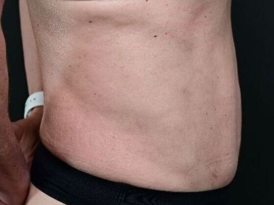 Tummy Tuck with Contouring: Case 8 - After