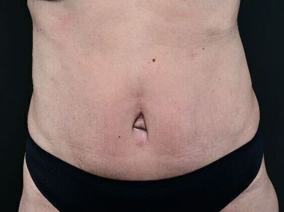 Tummy Tuck with Contouring: Case 8 - After