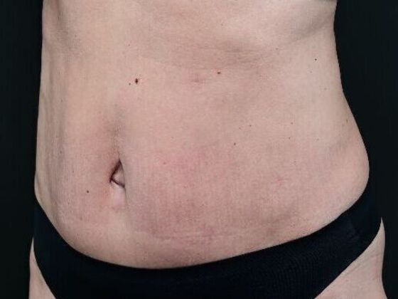 Tummy Tuck with Contouring: Case 8 - After