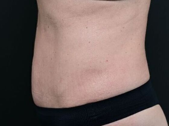Tummy Tuck with Contouring: Case 8 - After