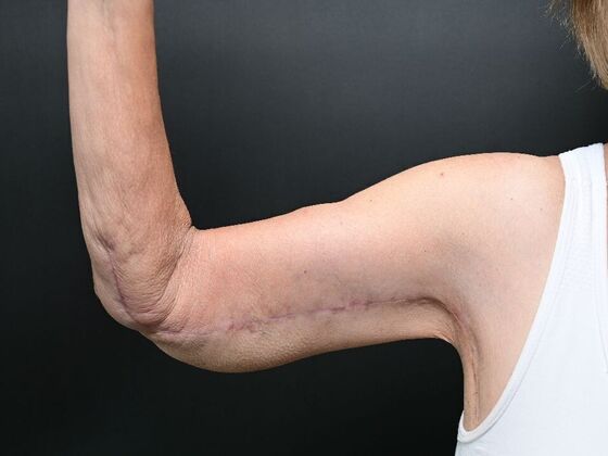 Arm Lift Surgery: Case 1 - After
