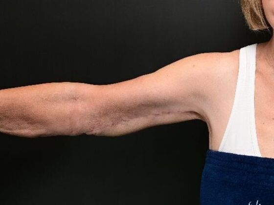 Arm Lift Surgery Case 1 - After