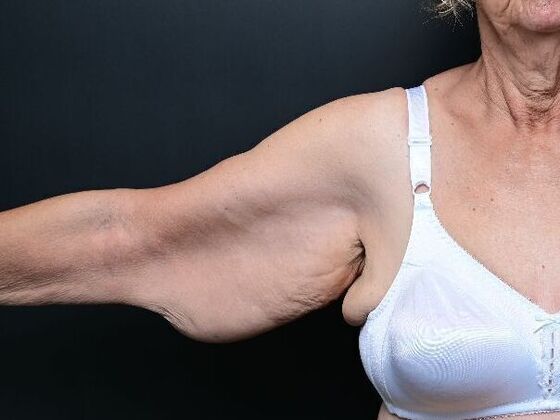 Arm Lift Surgery Case 1 - Before