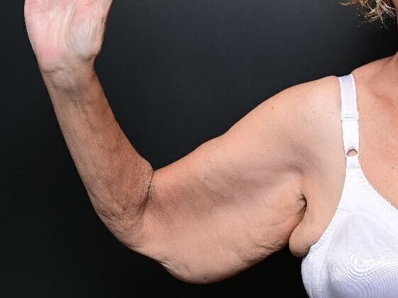 Arm Lift Surgery: Case 1 - Before