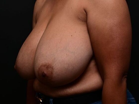 Breast Reduction: Case 3 - Before