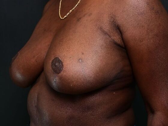 Breast Reduction: Case 4 - After