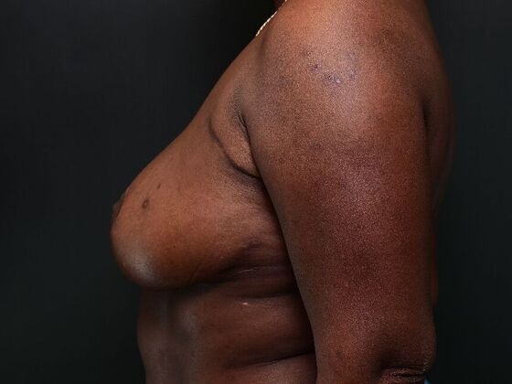 Breast Reduction: Case 4 - After