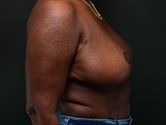 Breast Reduction: Case 4 - After