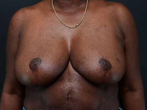 Breast Reduction Case 4 - After