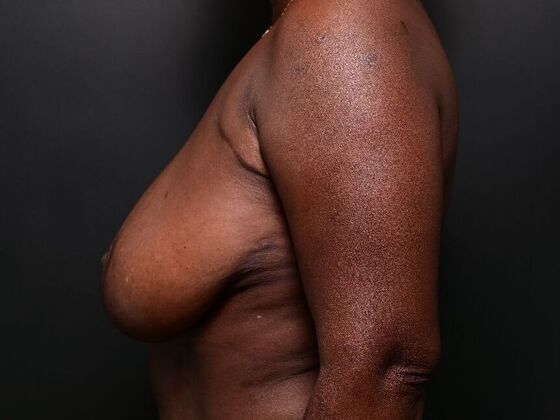 Breast Reduction: Case 4 - Before
