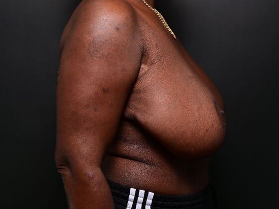 Breast Reduction: Case 4 - Before