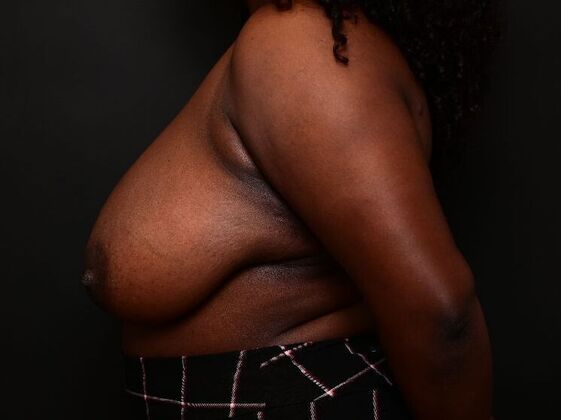 Breast Reduction: Case 6 - Before