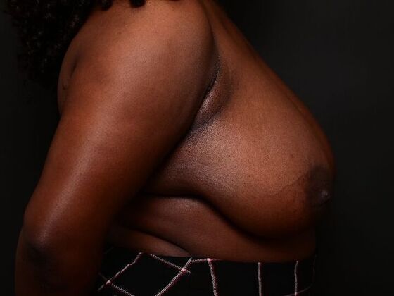 Breast Reduction: Case 6 - Before