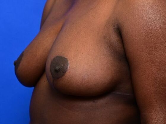 Breast Reduction: Case 6 - After