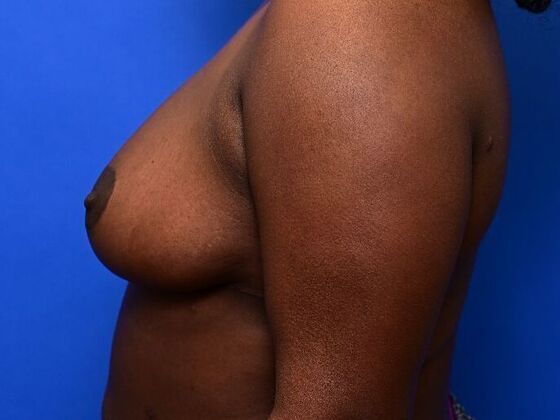 Breast Reduction: Case 6 - After