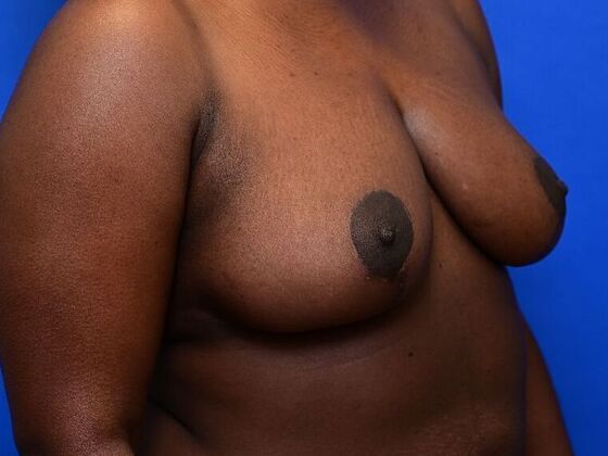 Breast Reduction: Case 6 - After