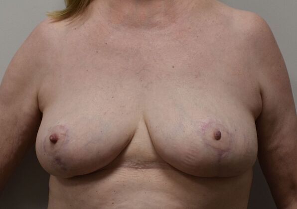 Breast Lift (Mastopexy) Case 248 - After