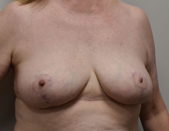 Breast Reduction: Case 199 - After