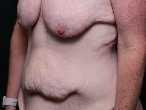 Post Bariatric Plastic Surgery: Case 1 - Before