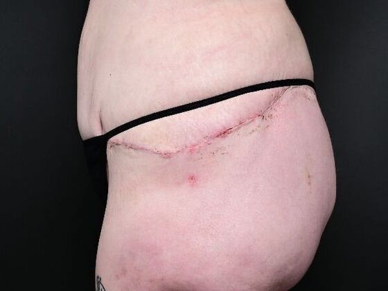 Post Bariatric Plastic Surgery: Case 1 - After