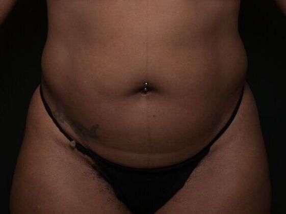 Tummy Tuck with Contouring: Case 9 - Before
