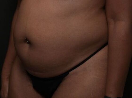 Tummy Tuck with Contouring: Case 9 - Before
