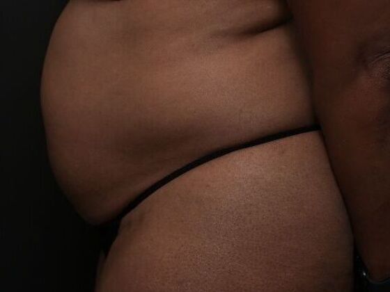 Tummy Tuck with Contouring: Case 9 - Before