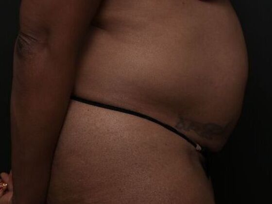 Tummy Tuck with Contouring: Case 9 - Before